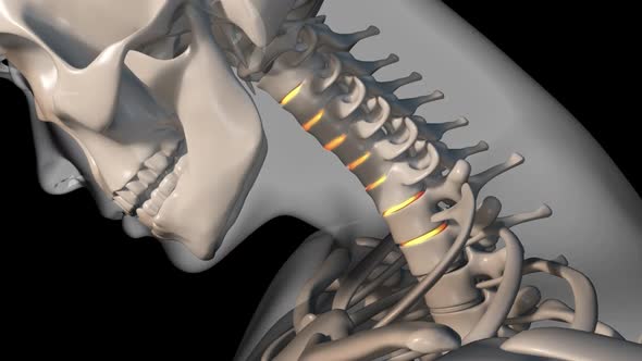 Whiplash Injury Of Cervical Spine