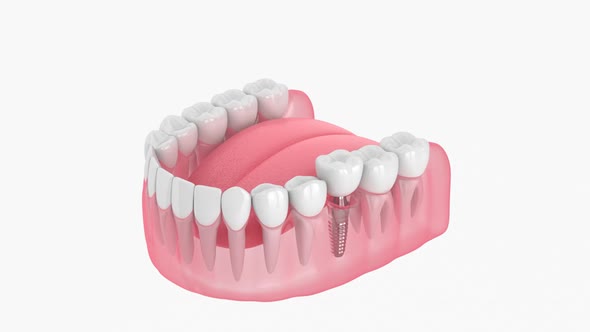 Dental implant placement over white background