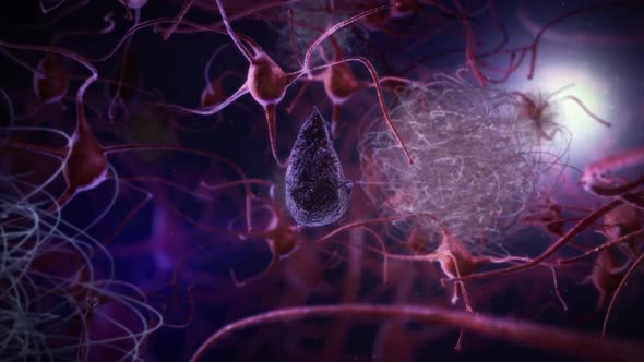 deathofneurons-Alzheimer.mov alt