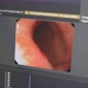 Endoscopy Esophagus Diagnosis With Neural Network Analysis - VideoHive Item for Sale