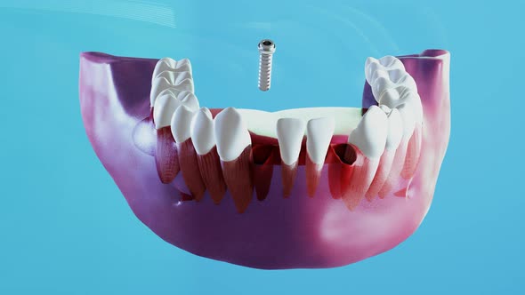 Ceramic Dental Implantation Process