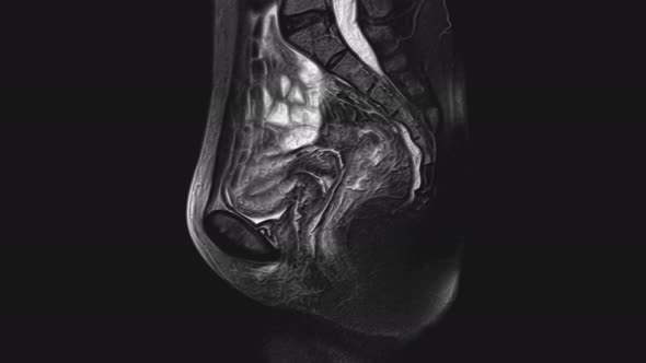 Voluminous MRI of the Female Pelvic Organs, Abdominal Cavity, Gastrointestinal Tract and Bladder