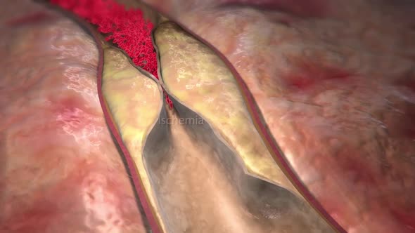 Plaque formation in the cardiovascular tract