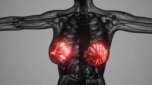 Medical Scan of Woman Breast Cancer