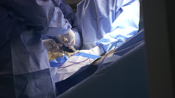 Surgeons working during surgery, close up on hands and instruments.