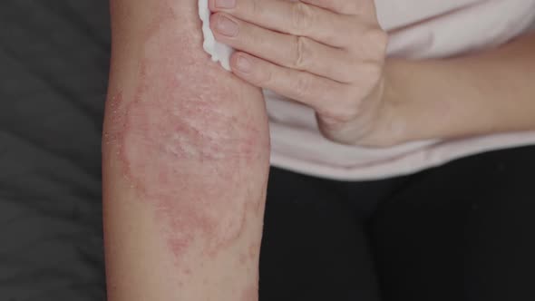 Woman with Dermatitis Using Healing Lotion