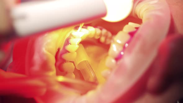 Oral Cavity with Gums Getting Treated in a Close Up