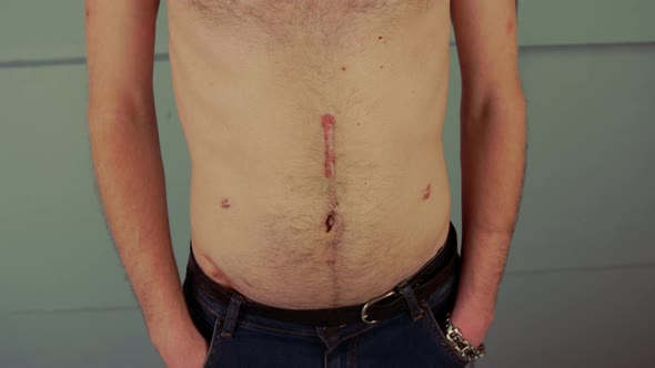 Anonymous Shirtless Man with Scars on Body