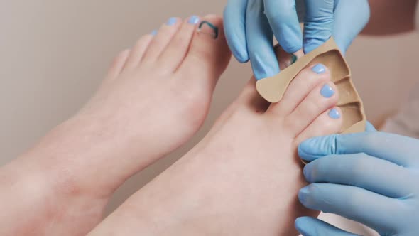 Podologist hands in blue medical gloves insert a silicone fixator to a client's foot