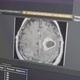 Brain Tumor MRI Dataset Analysis Deep Learning Model Creation on Screen - VideoHive Item for Sale