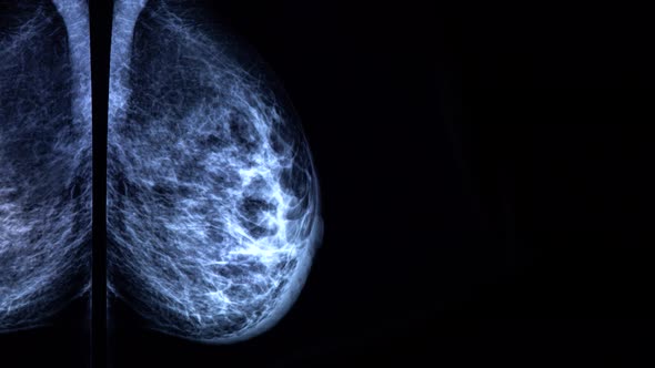 Doctor with a pen zooms and checks a mammogram x-ray on a big sensor screen. 