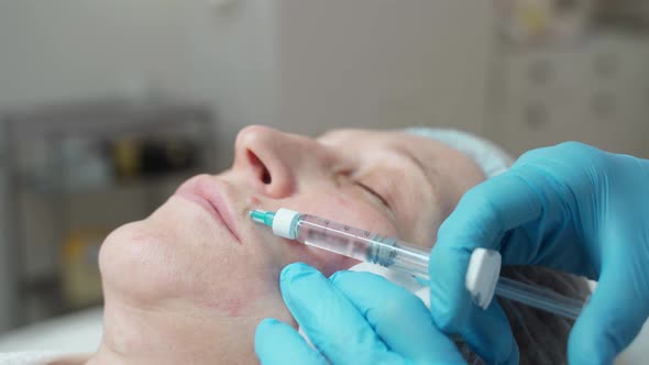 The Cosmetologist Makes an Injection of Hyaluronic Acid Into the Skin of the Face of an Adult Woman
