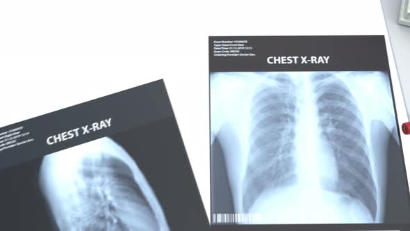 2 X-ray Images of the Lung and Positive Analysis 4k alt