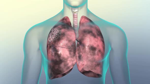 Human respiratory system.Lungs damaged by smoking