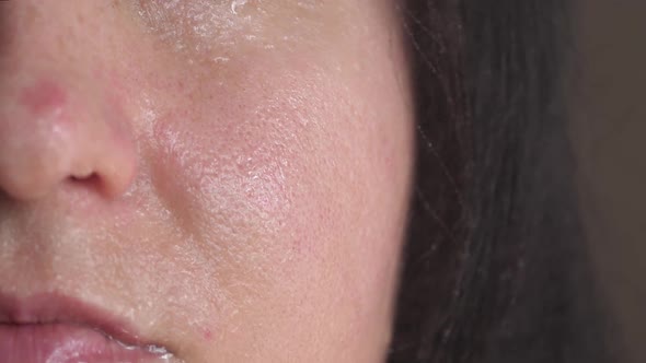 Skin with Enlarged Macro Pores