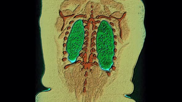 3D Color MRI Scan of The Lungs and Bronchi