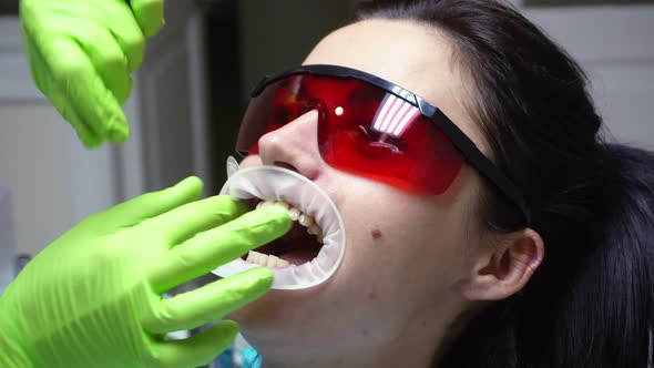 Closeup View of the Dentist's Hands Putting Rubber Dam in a Mouth of a Female Patient