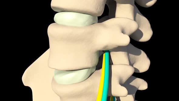 inflammation of the Sciatic Nerve