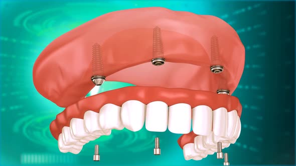 Teeth And Dental Implant