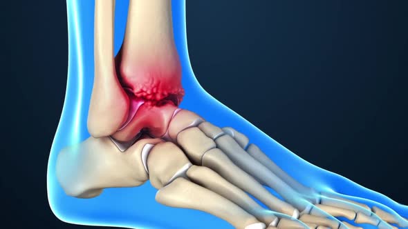 Osteoarthritis is the most common form of arthritis