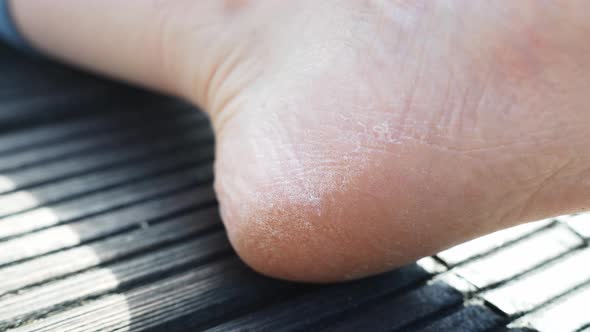 Close up of a cracked and dry heel on a bare foot. People skin care