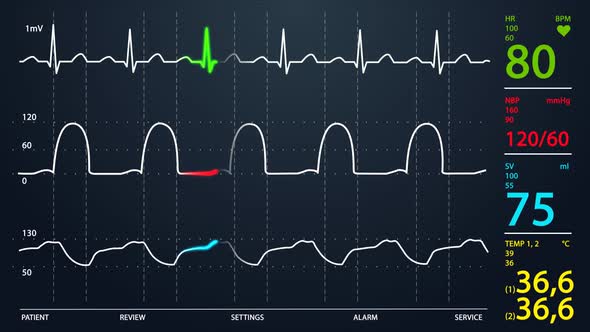 Animation of Intensive Care Unit monitor showing normal values for vital signs.