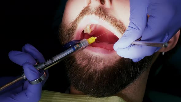 Man with Open Mouth During Dental Procedure
