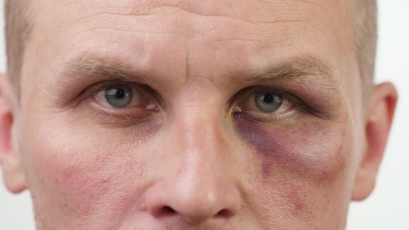 Bruise on the Eye of a Man