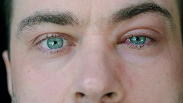 Close Up of Man with One Swollen Infected Eye with Symptom of Conjunctivitis