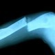 Bone Breaking 03