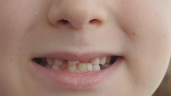 Change of Baby Teeth in a Child