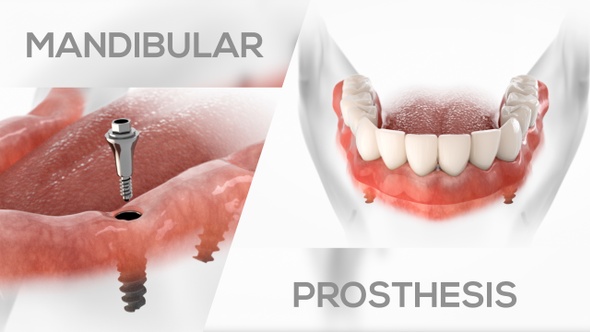 Mandibular Prosthesis