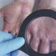 The doctor examine Dermatitis sore skin use a magnifying glass. Allergy Diabetes Eczema - VideoHive Item for Sale