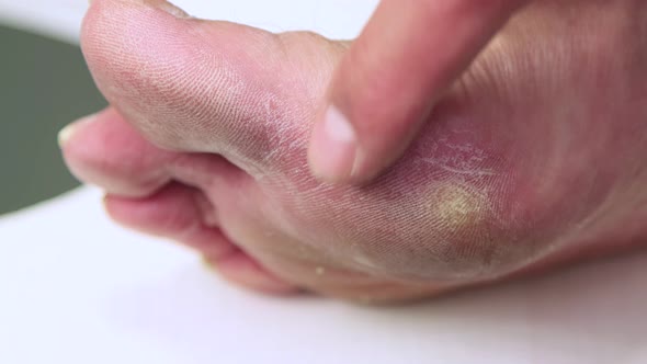 The Index Finger Shows a Callus on the Foot Below the Big Toe