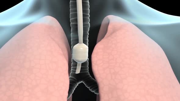 Intubation, endotracheal tube