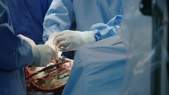 Surgeons working during open heart surgery, close up on hands and instruments.