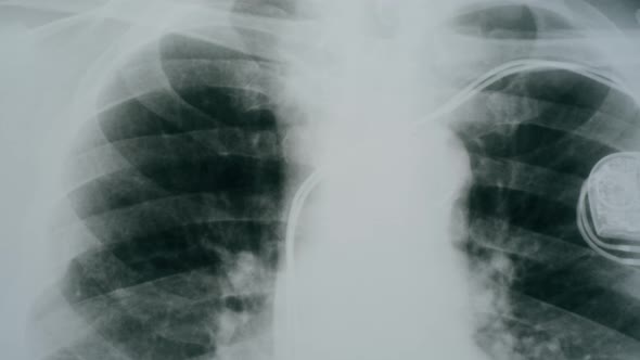 Lungs Xray Closeup
