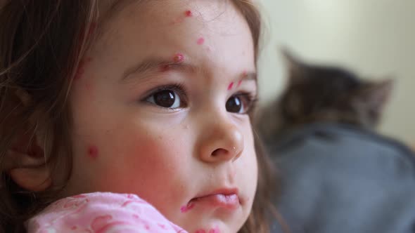 Toddler Girl with Chickenpox Measles on the Body