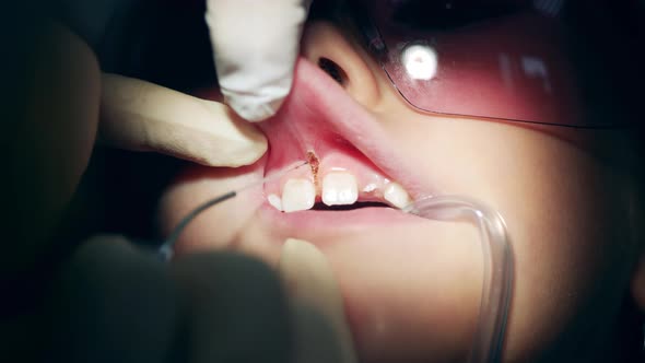 Close Up of Woman's Gums Getting Fixed By a Dentist