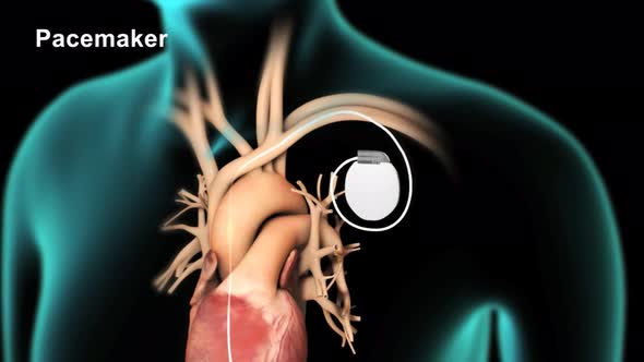 Pacemakers are installed in angio catheter laboratories