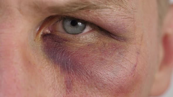Bruise Under the Eye of a Man