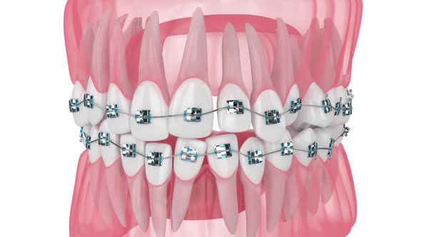 Teeth alignment by orthodontic braces isolated over white background