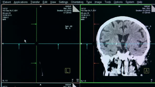 Depiction of a Human Brain Case Is Being Shown on a Scanning Monitor