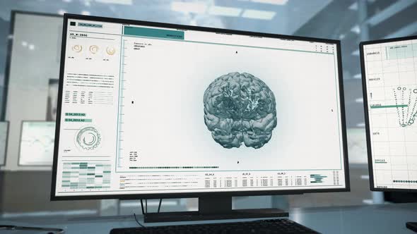 Medical diagnosis system has analyzed the brain and found the dangerous tumor
