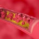 a Blood Clot Clogs a Vessel Affected By a Cholesterol Plaque Cross Section View - VideoHive Item for Sale