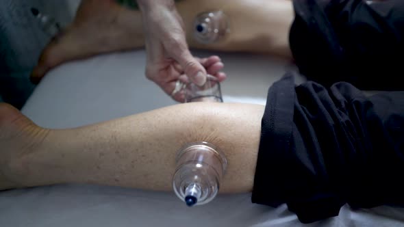 Tight shot of cupping on a caucasian woman’s leg and foot as therapist checks the suction on each cu