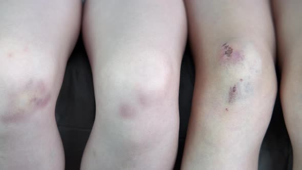 Two girls show bruises on legs with pain in the room