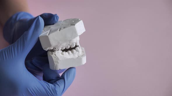 Gypsum Model of the Teeth Before Installing the Bracket System