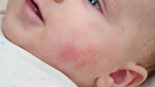 Closeup of Baby Face Skin with Pimples and Acne From Dermatitis