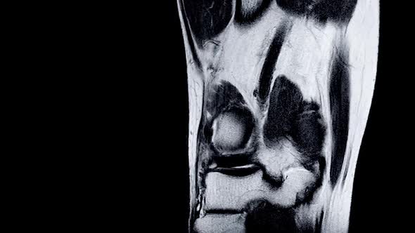 Magnetic Resonance Imaging (MRI) of Right Knee